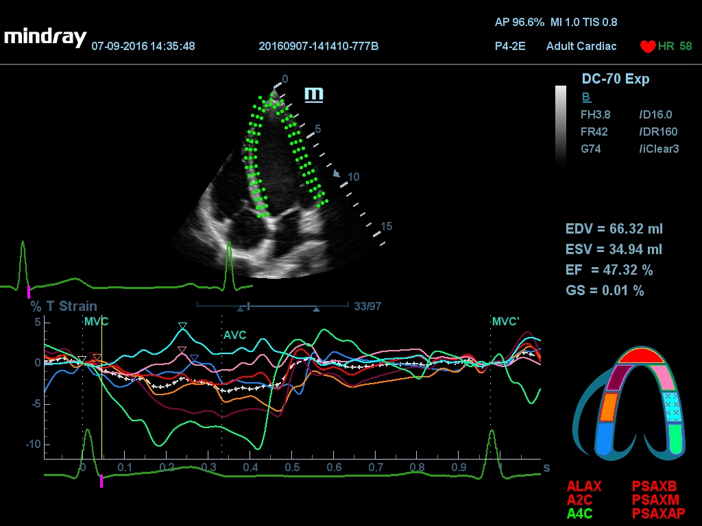 MINDRAY DC-70 X-nsight