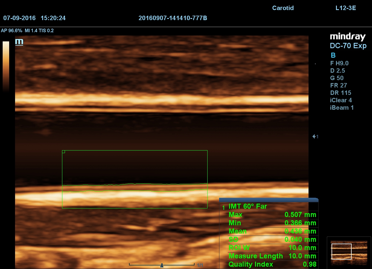 MINDRAY DC-70 X-nsight
