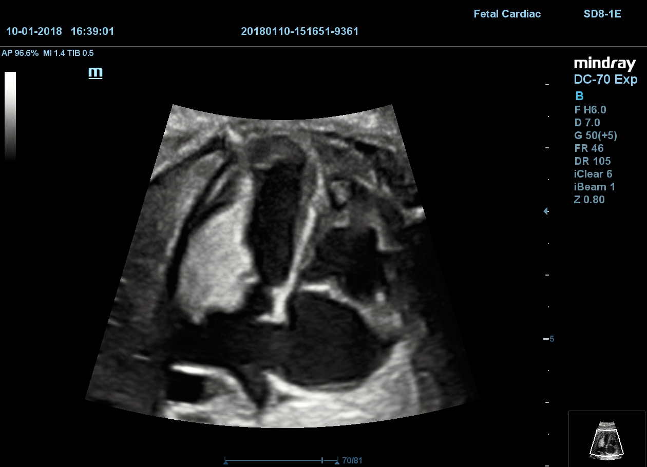 MINDRAY DC-70 X-nsight