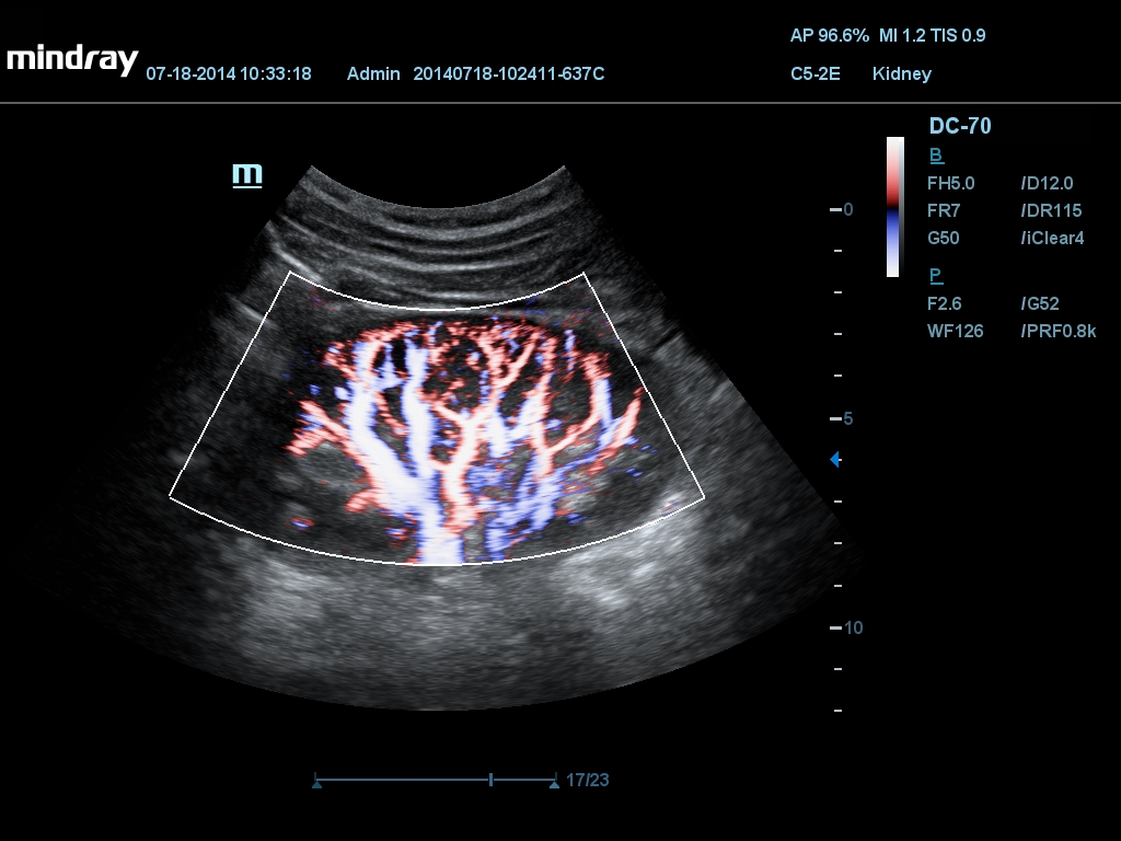 MINDRAY DC-70 X-nsight