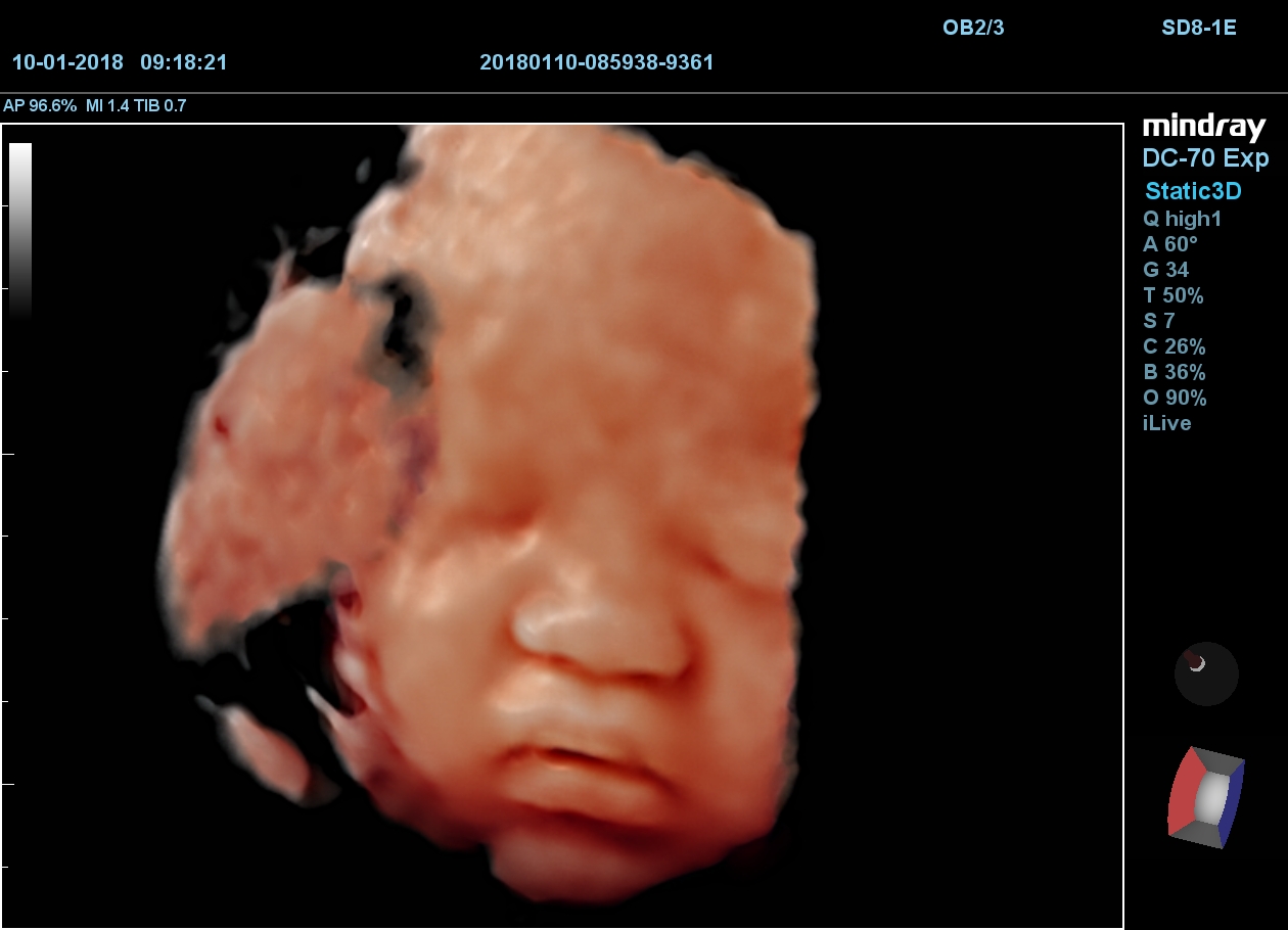 MINDRAY DC-70 X-nsight