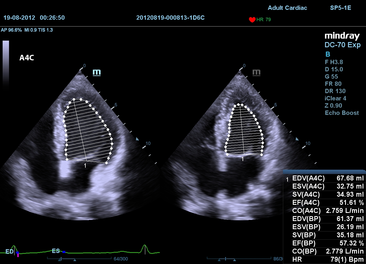 MINDRAY DC-70 X-nsight