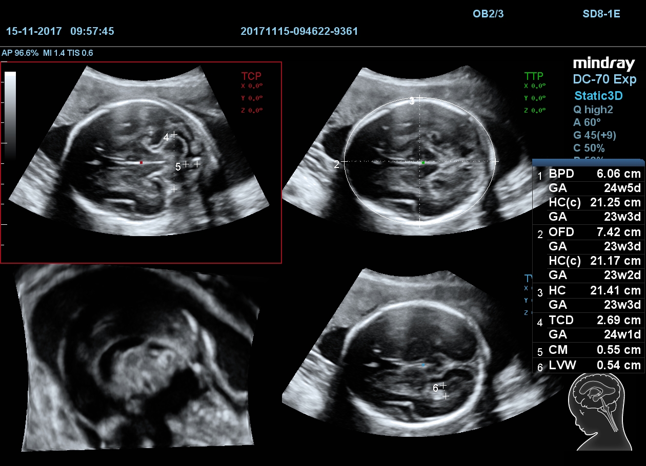 MINDRAY DC-70 X-nsight