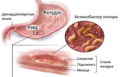 Бактерия хеликобактер пилори
