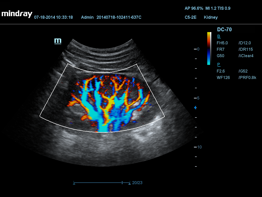 MINDRAY DC-70 X-nsight
