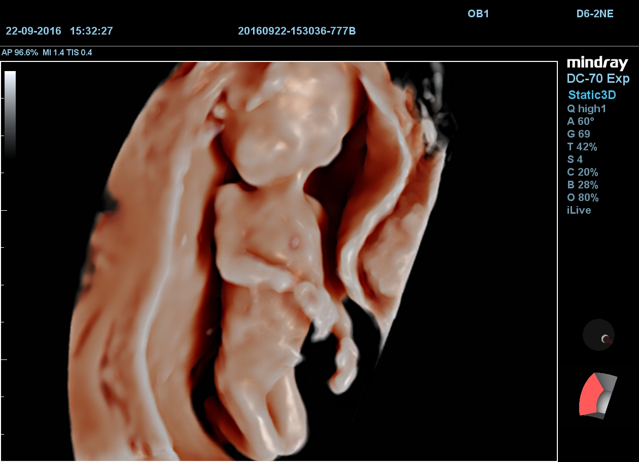 MINDRAY DC-70 X-nsight