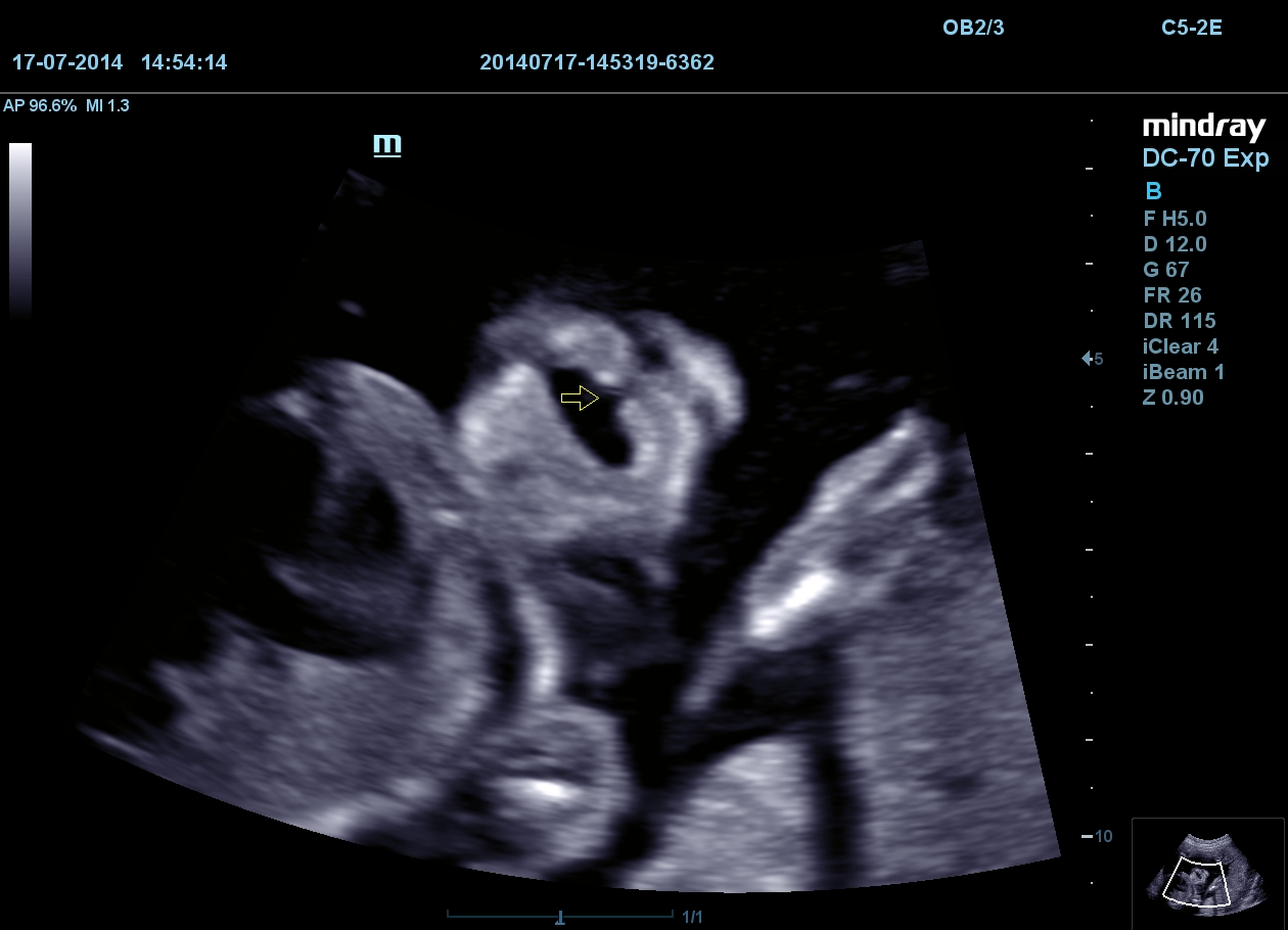 MINDRAY DC-70 X-nsight