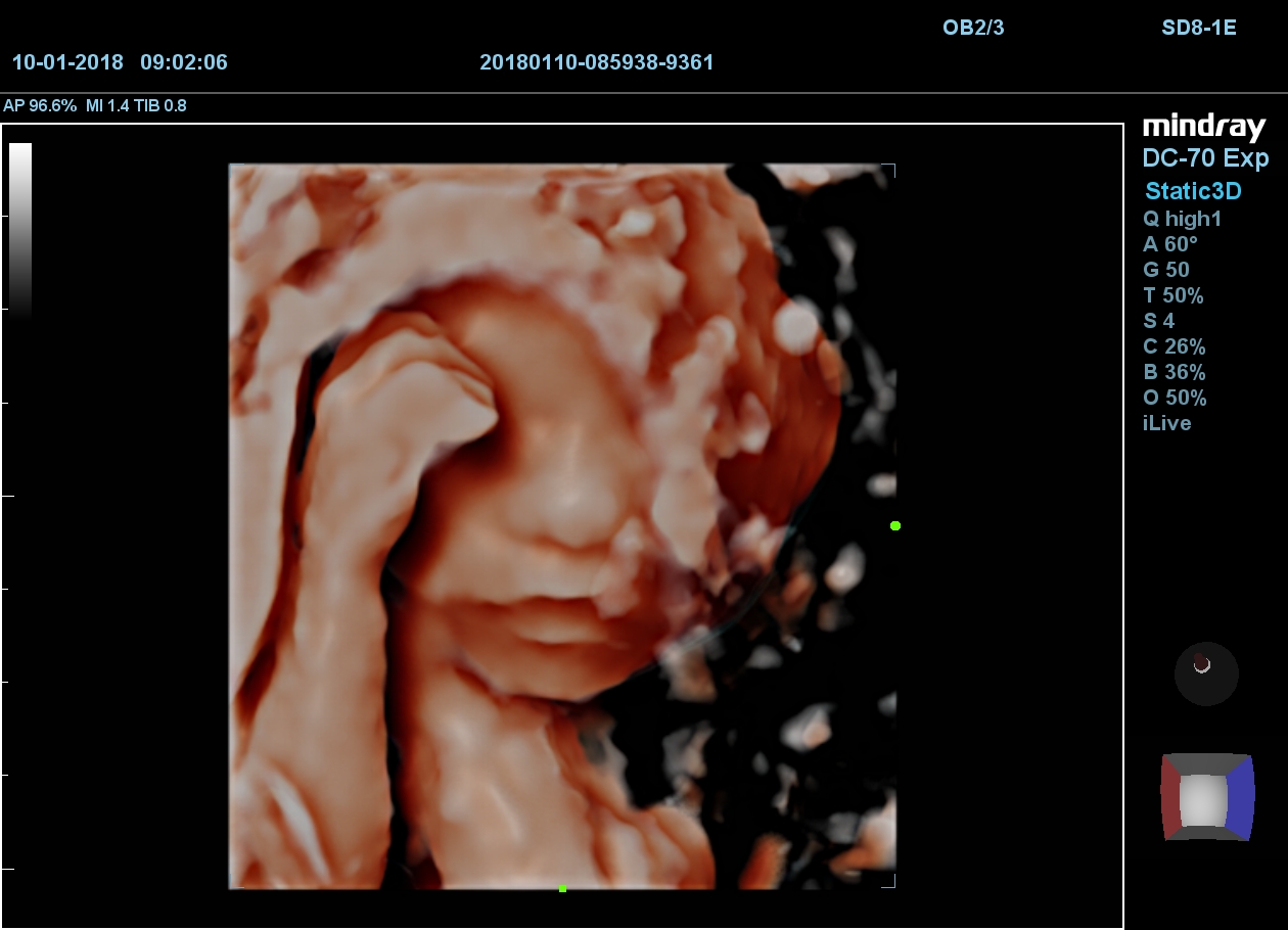 MINDRAY DC-70 X-nsight