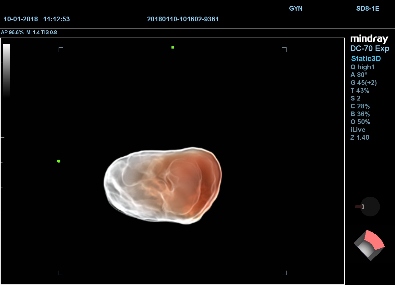 MINDRAY DC-70 X-nsight