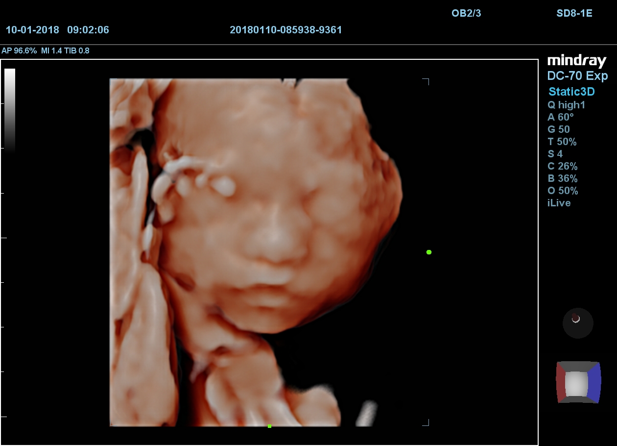 MINDRAY DC-70 X-nsight